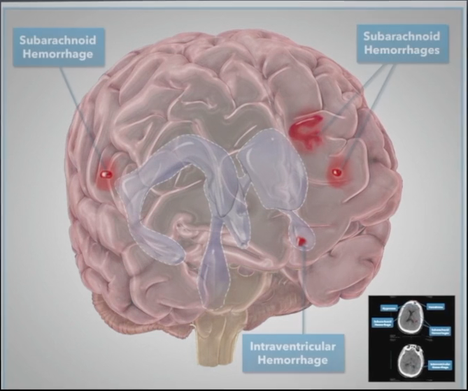 Major Types of Traumatic Brain Injury